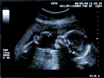 Ultrasound-Scan-Baby-image-iStock